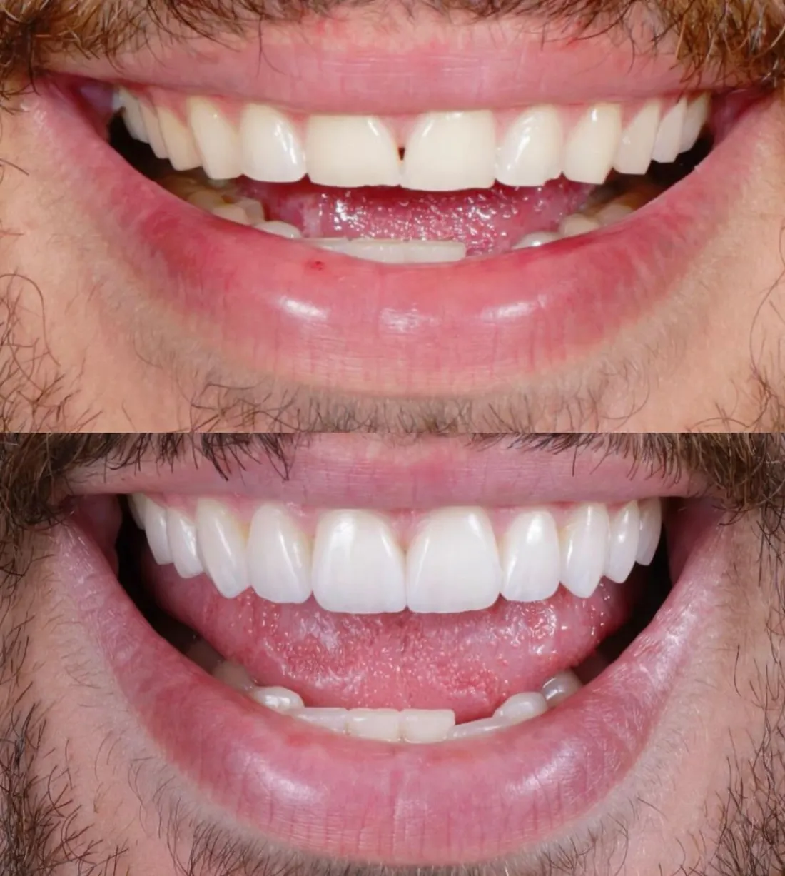 Caso clínico: Antes e depois em vista aproximada do sorriso