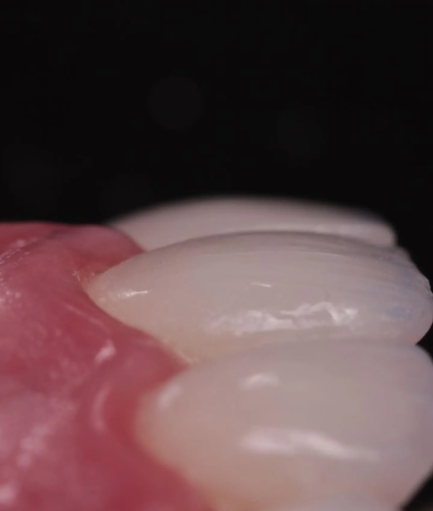 Detalhe macro de lente de contato dental em porcelana sobre o dente