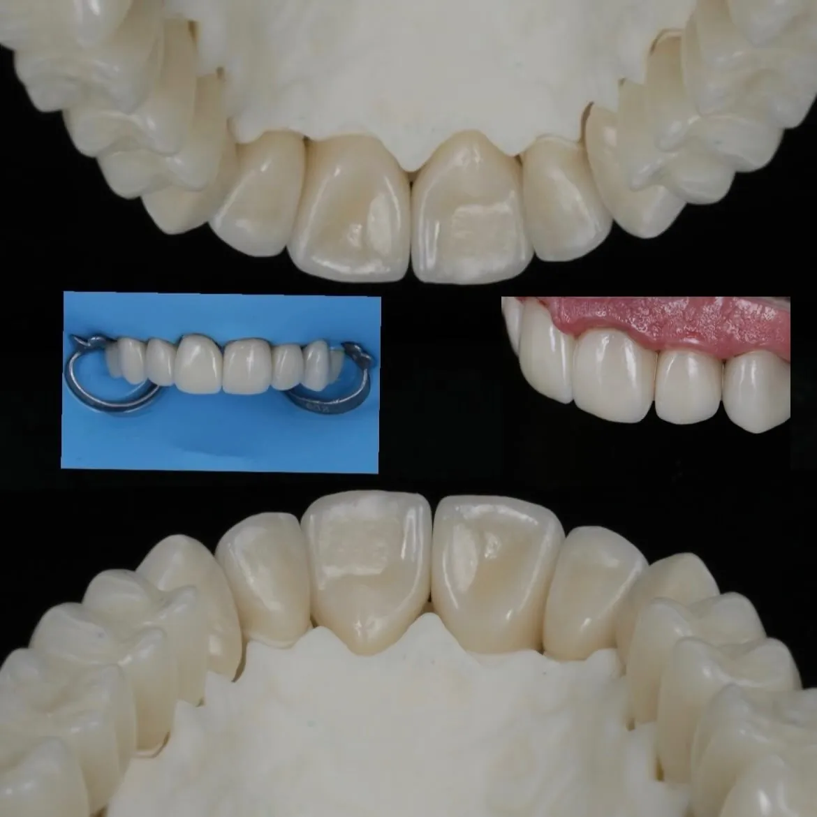 Peças cerâmicas finalizadas pelo laboratório sobre modelo de trabalho