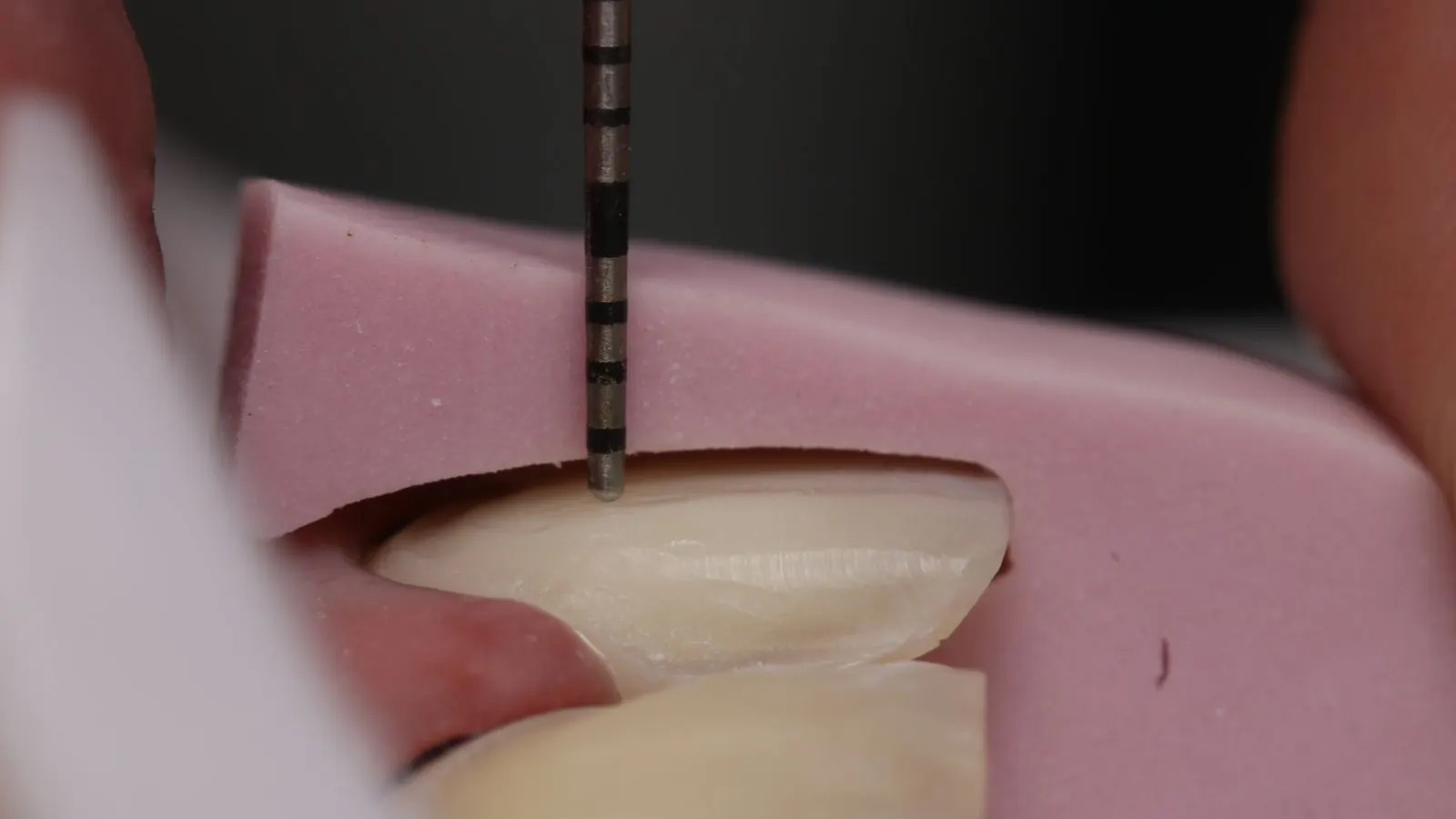 Preparo para prótese dentária estética com atenção ao contorno gengival