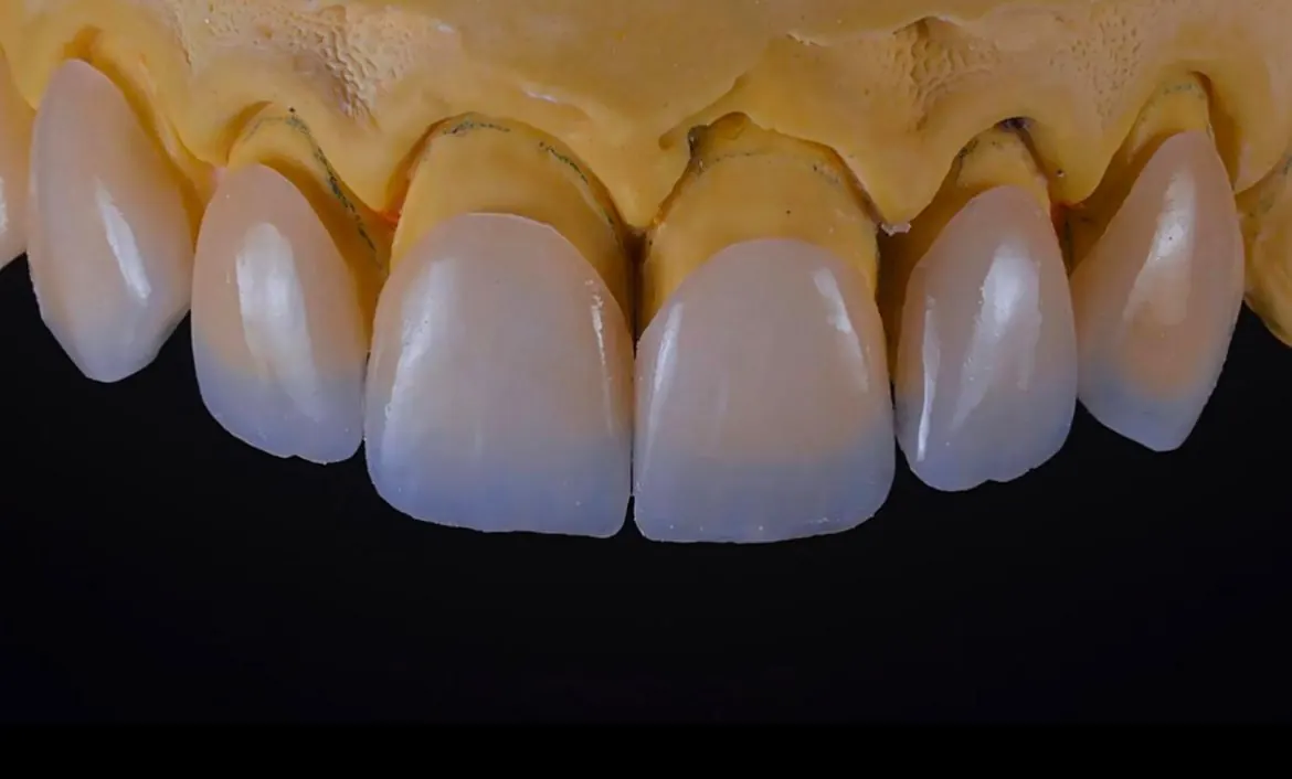Faceta em resina composta estratificada em camadas sobre dente anterior