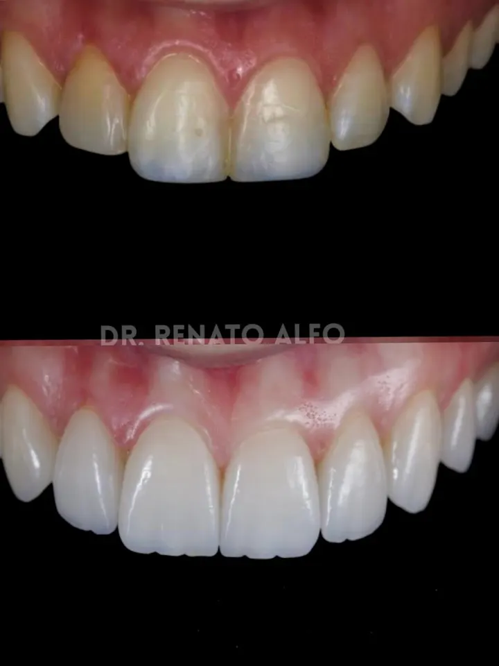 Caso real de sorriso tratado no consultório do Dr. Renato Alfo