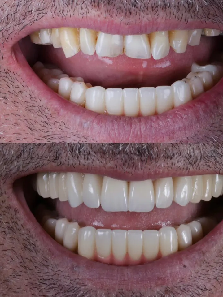 Caso real de sorriso tratado no consultório do Dr. Renato Alfo