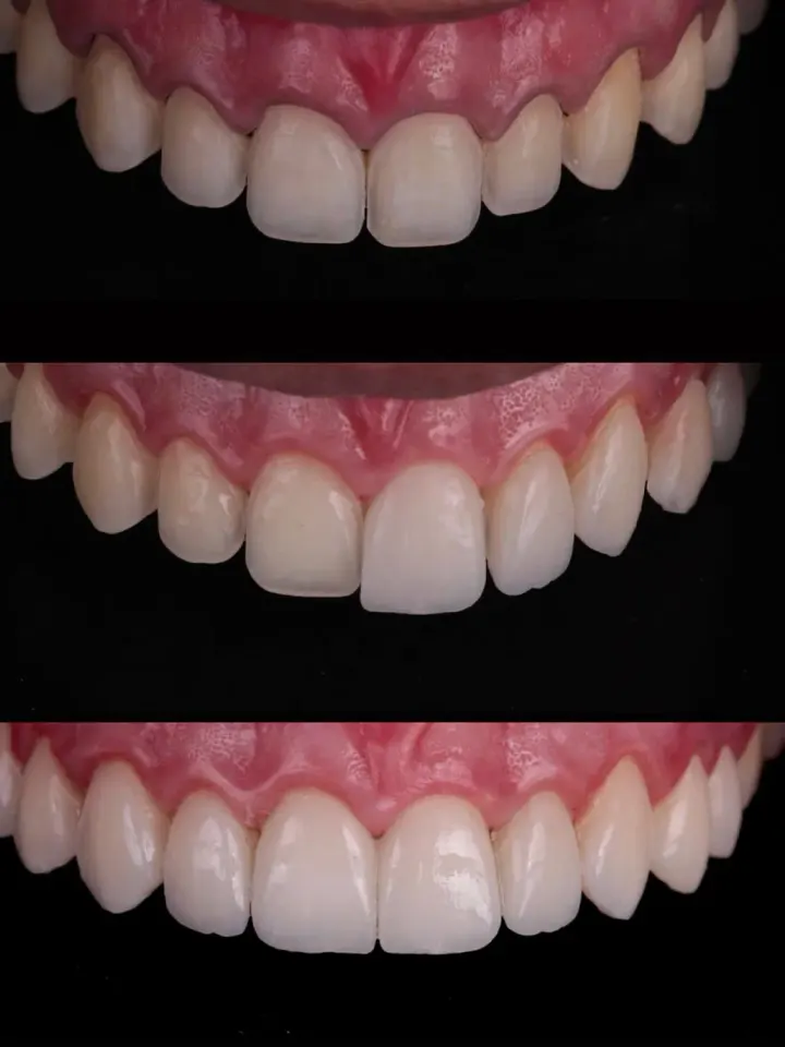 Antes e depois de tratamento estético realizado pelo Dr. Renato Alfo