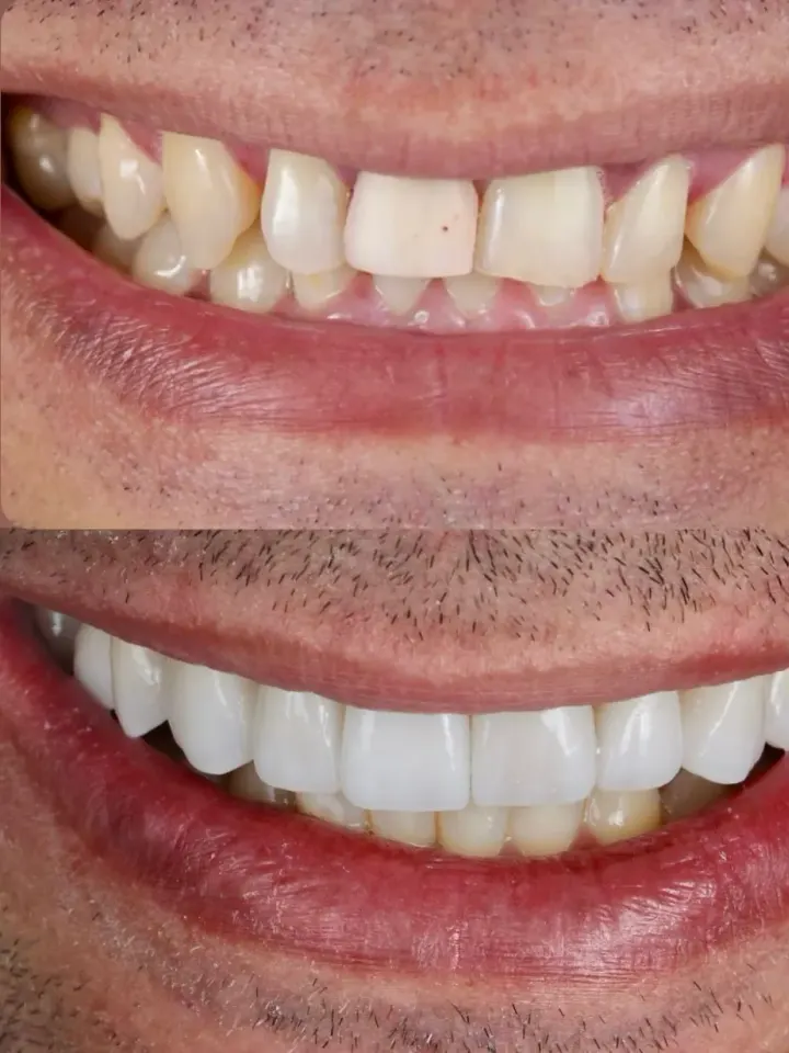 Antes e depois de tratamento estético realizado pelo Dr. Renato Alfo