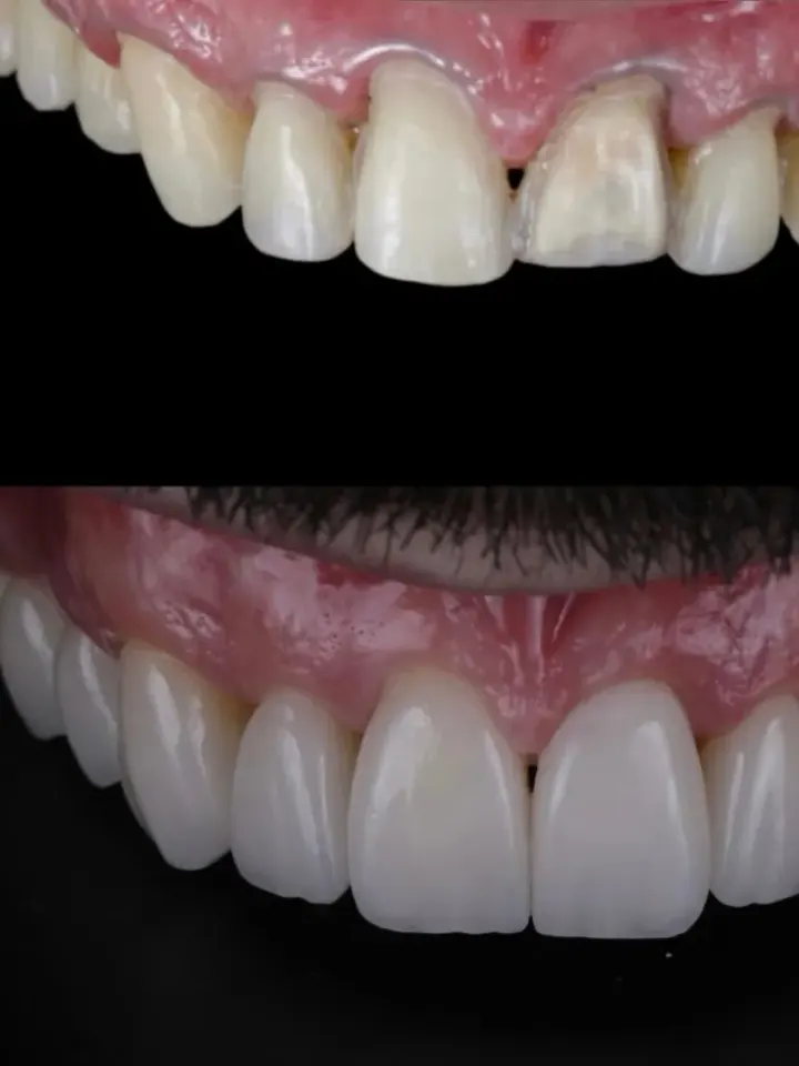 Antes e depois de tratamento estético realizado pelo Dr. Renato Alfo