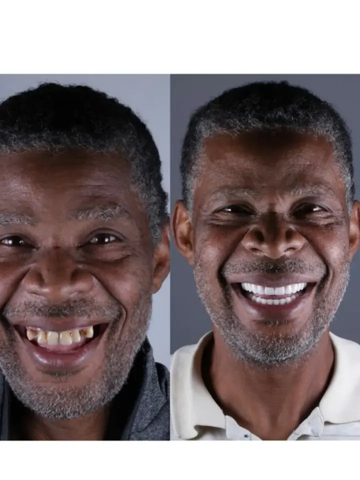 Antes e depois de tratamento estético realizado pelo Dr. Renato Alfo
