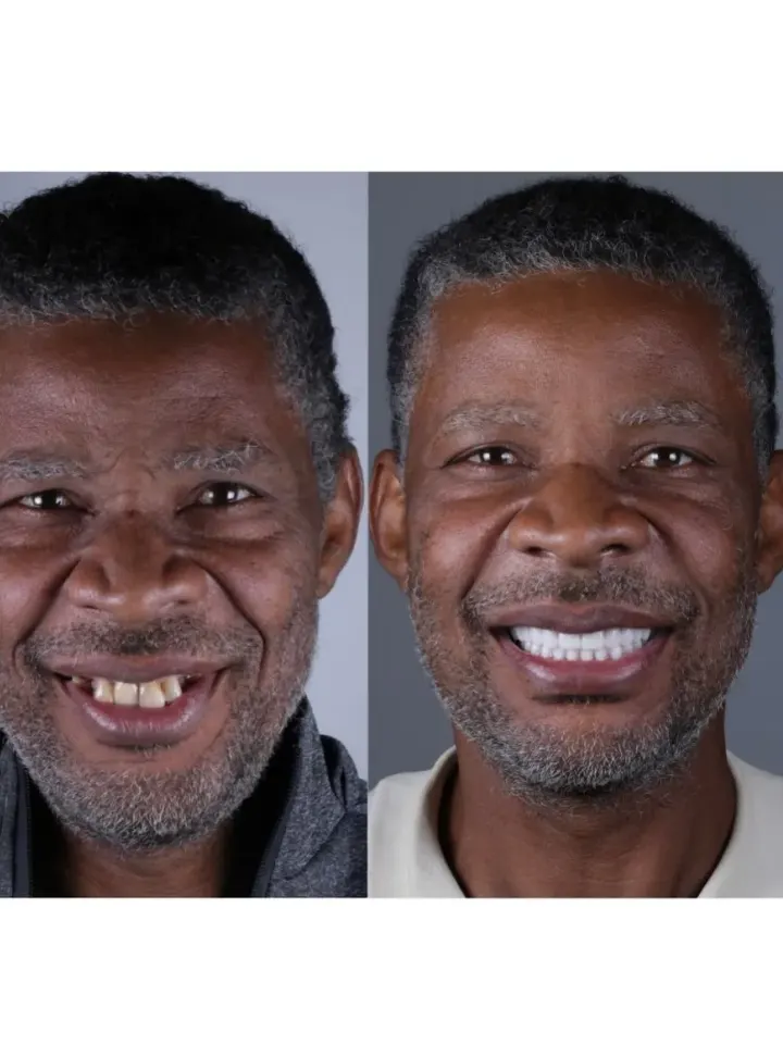 Antes e depois de tratamento estético realizado pelo Dr. Renato Alfo